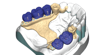 exocad PartialCAD (Perpetual Initial Purchase)